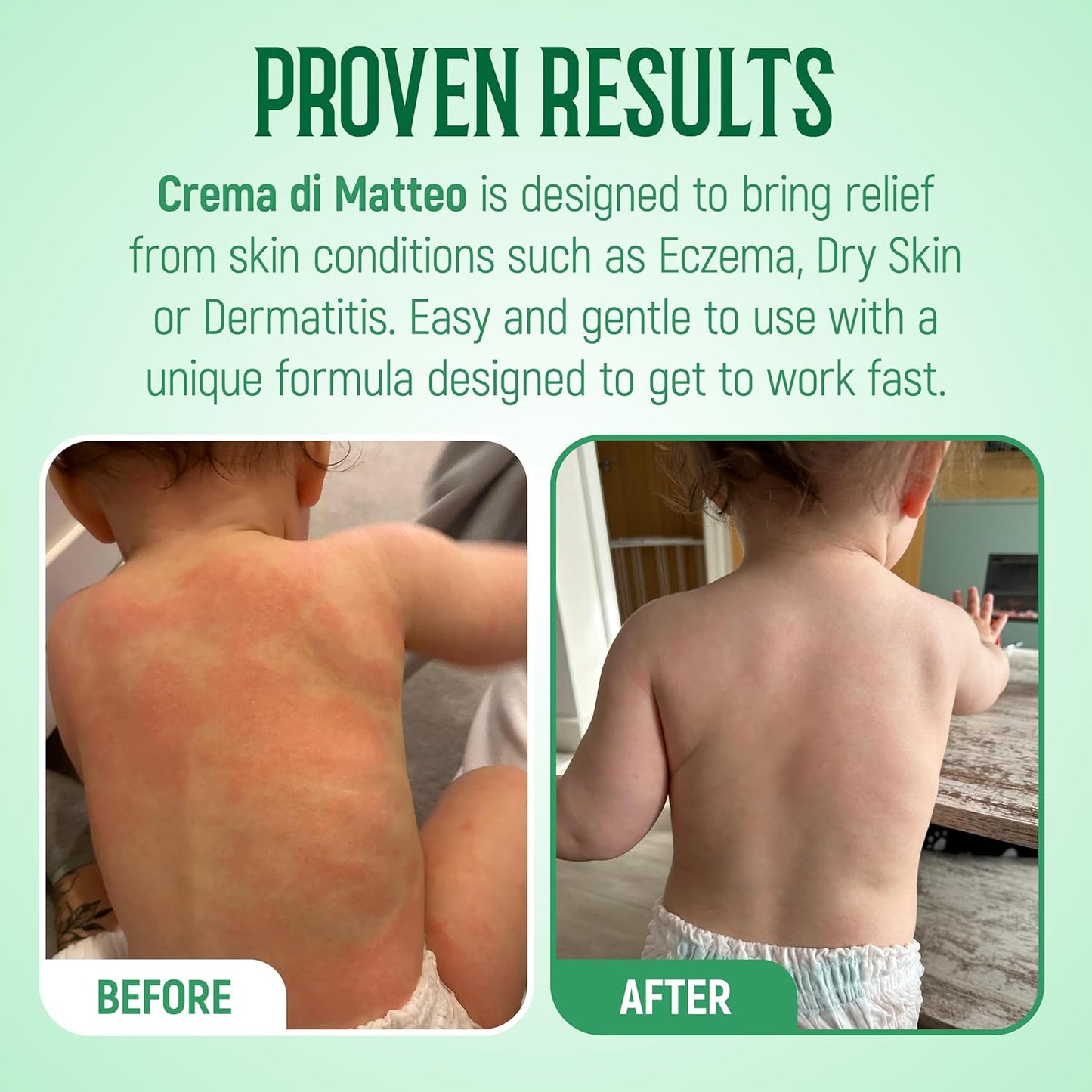 1936 Original Crema Di Matteo Cream, 100ml (Pack of 1) | Helps with Dermatitis, Eczema, Itchy Dry Skin | Baby, Kids, Adults